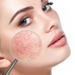 ROSACEA