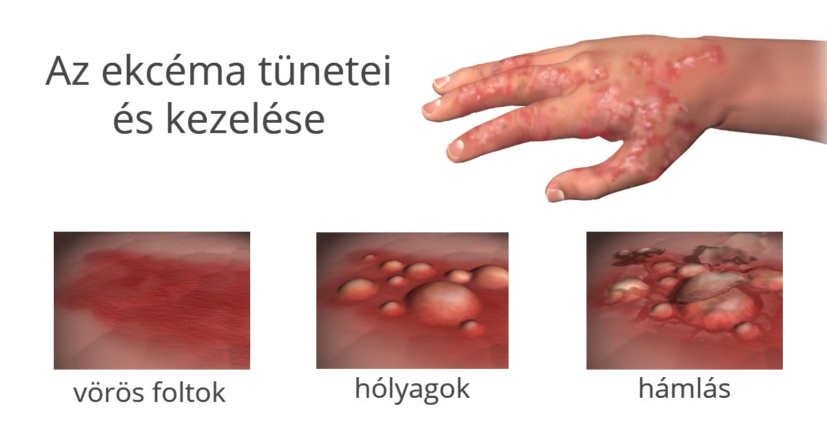 gombás ekcéma kezelése psoriasis wound healing