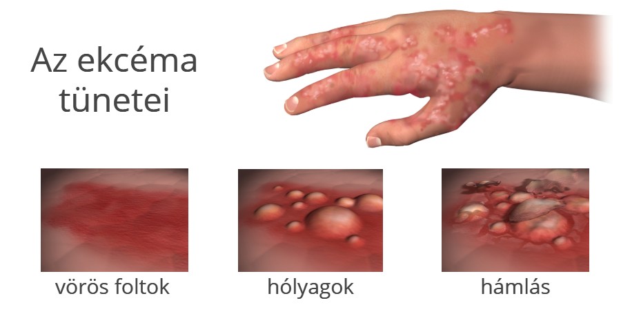 Az ekcéma tünetei