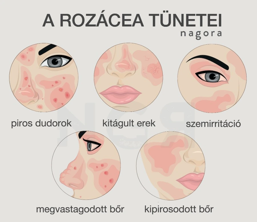 rozacea tünetek