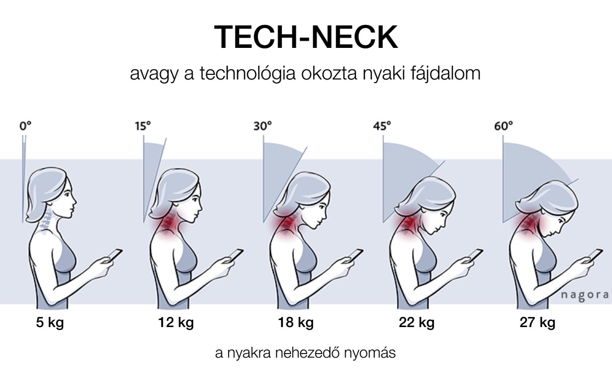 Tech-neck mitől alakul ki