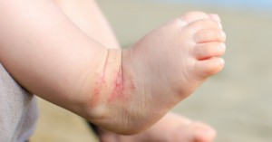 6 tipp az ekcémás baba bőrének kezelésére 