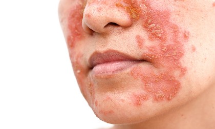 A seborrheás dermatitisz és a zsíros bőr nyomában – így kezelheted ezeket a bőrállapotokat!